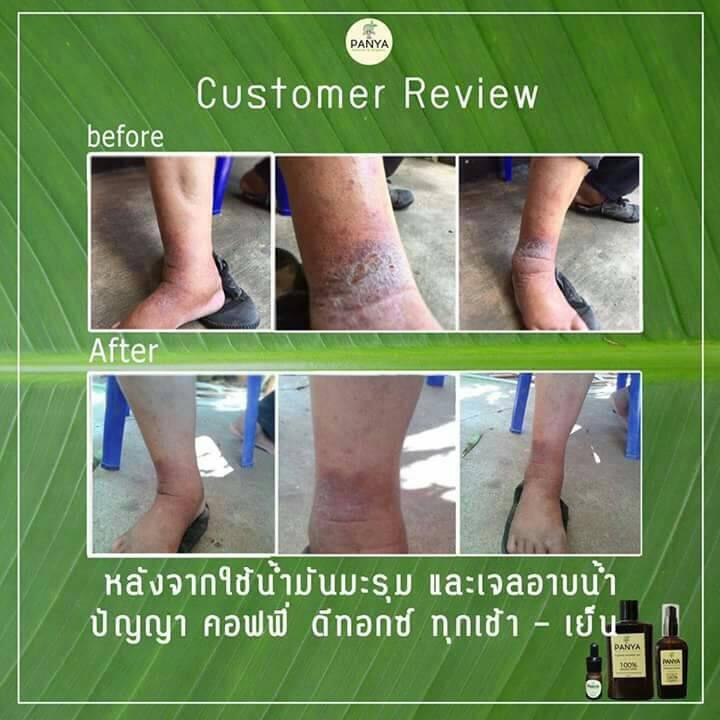 Before and after using Panya Coffee Detox, showing smoother and clearer skin results.