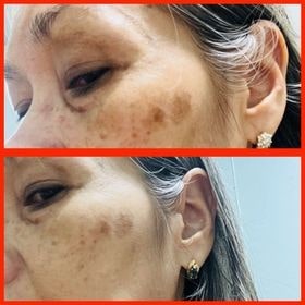 Before and after using Panya product, showing healthier, glowing facial skin results.